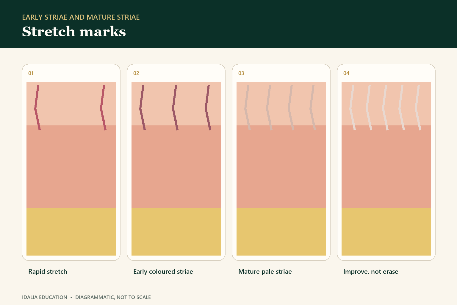 Stretch marks